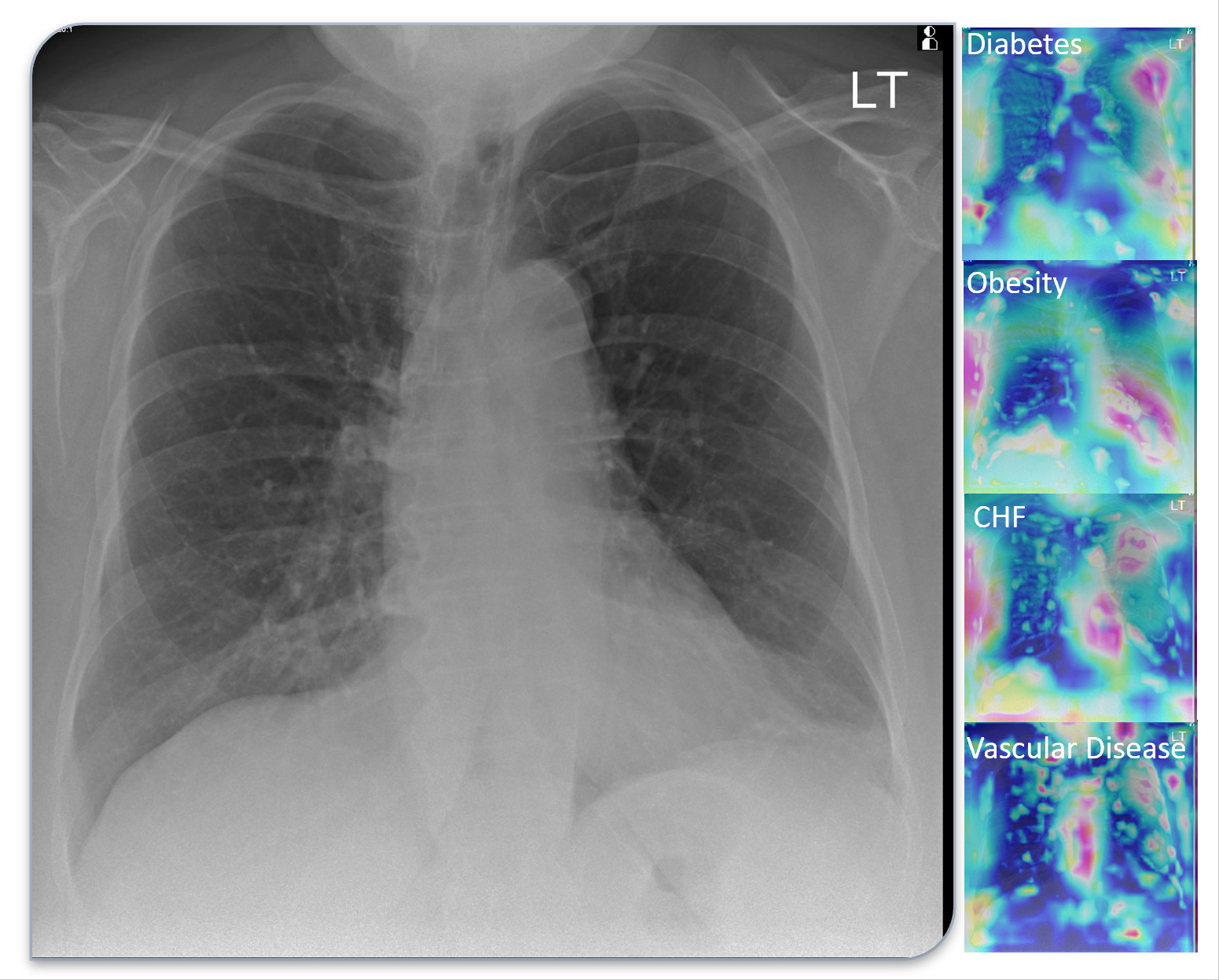 This image models a 70-year-old female patient with COVID19 hospitalized for 9-days. The deep learning model predicted diabetes, obesity, congestive heart failure and vascular disease, which were verified upon chart review, but several of these conditions were only found after extensive chart searching.