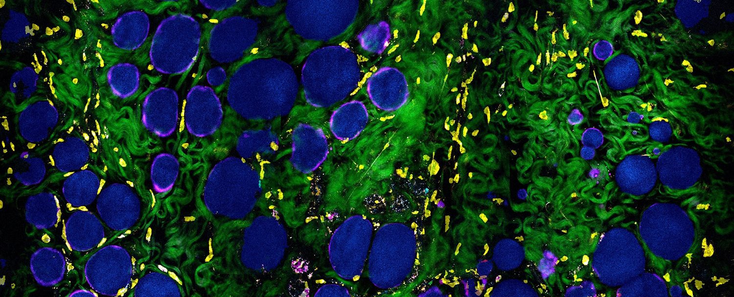 The cover image for Cancer Research, May 2021Volume 81, Issue 9.